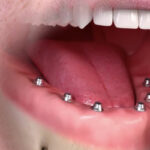 Dr Vigneron dents implants