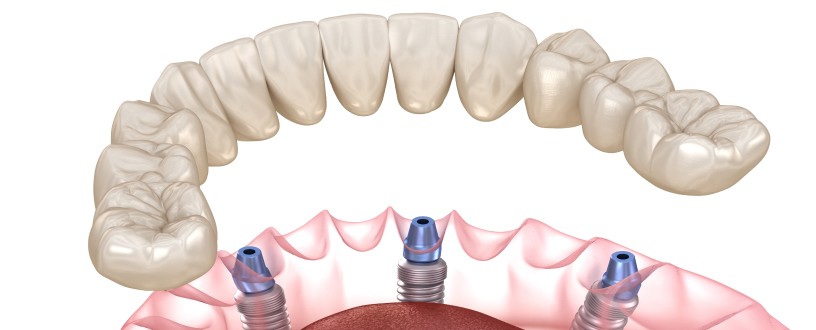 Vos implants dentaires à Les Hôpitaux-Neufs