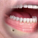 Dr John Vigneron implants remplacements dents