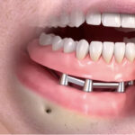 Dr Vigneron implants remplacements dents